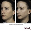 fraxel-re-store-dual-wavelength-sommersprossen_klein1 fraxel-re-store-dual-wavelength-sommersprossen_klein1